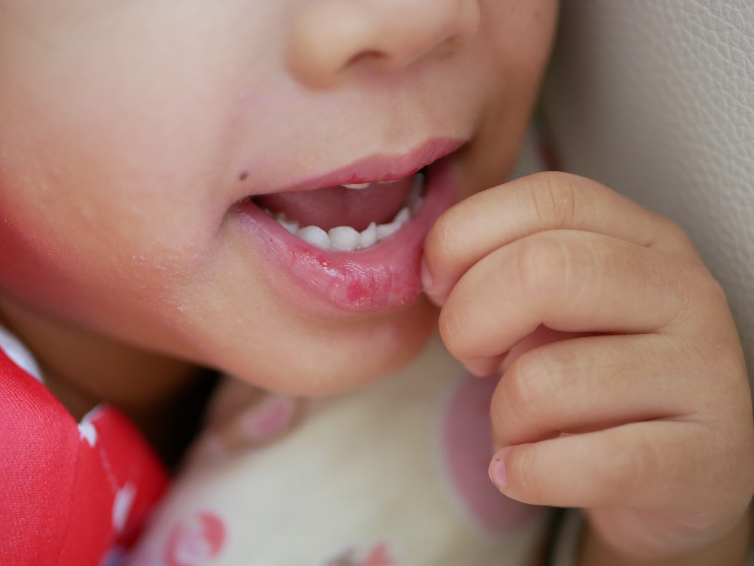 How to Help Your Child Stop Lip Picking